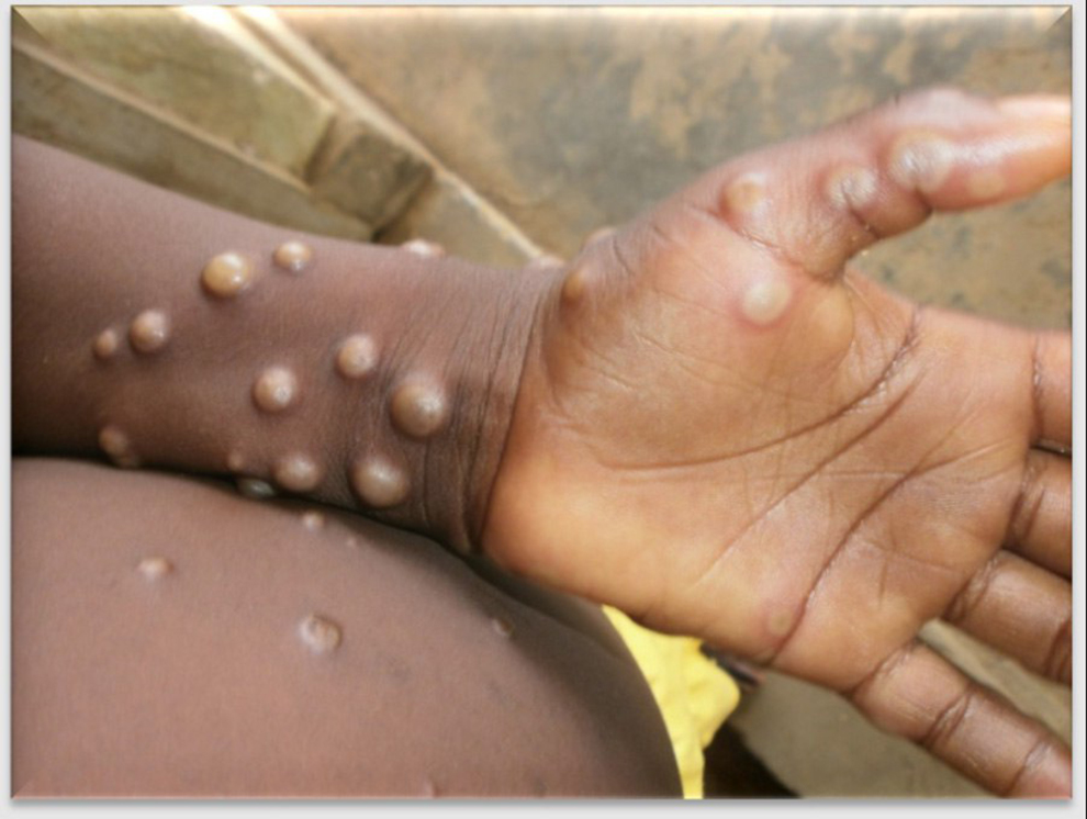 An infected individual’s hand and arm shows multiple raised, fluid-filled lesions, characteristic of a severe manifestation of mpox. WHO
